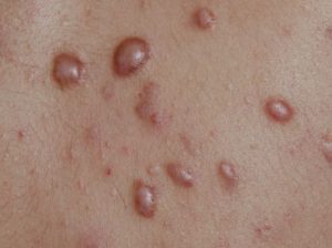 litteken acne acnelitteken hypertrofisch