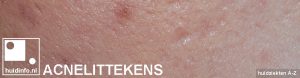 acnelittekens acne litteken