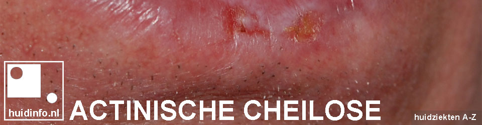 actinische cheilose cheilitis