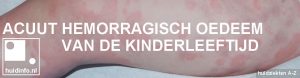 Acuut hemorragisch oedeem van de kinderleeftijd Finkelstein