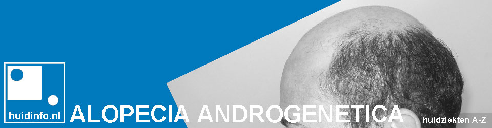 alopecia androgenetica