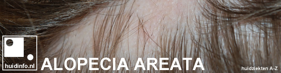 alopecia areata