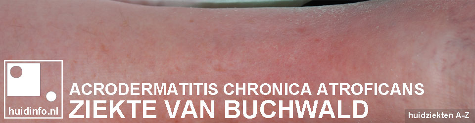 buchwald lyme acrodermatitis