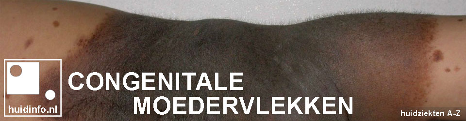 congenitale moedervlek naevus