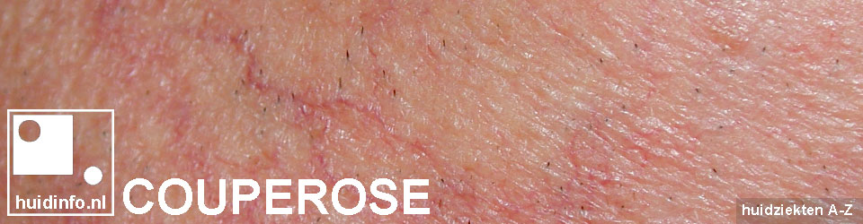 couperose rosacea