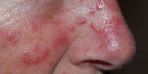 acne rosacea