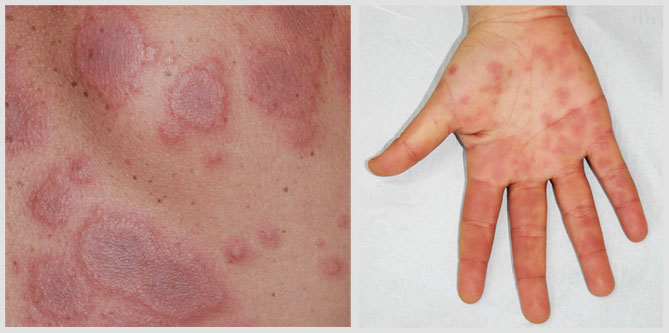 erythema multiforme