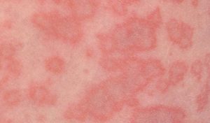 erythema infectiosum vijfde ziekte