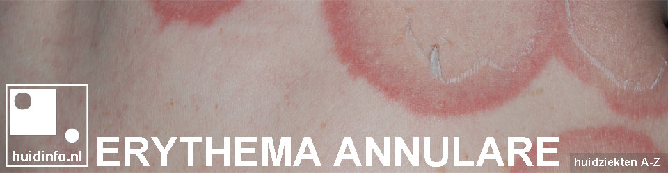 erythema annulare