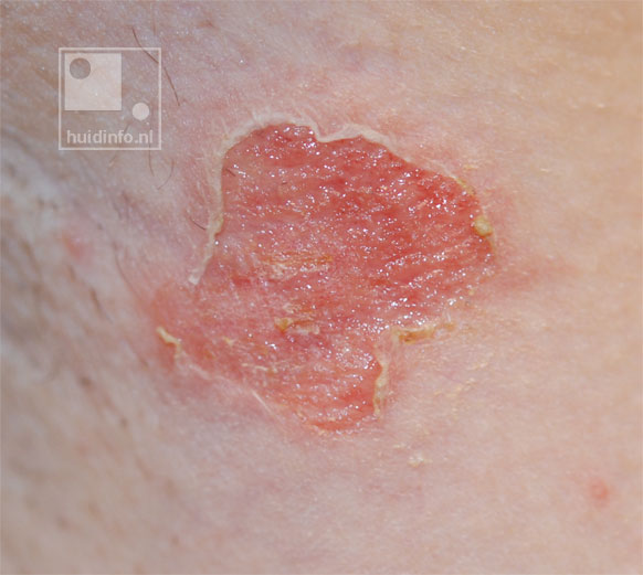 krentenbaard impetigo