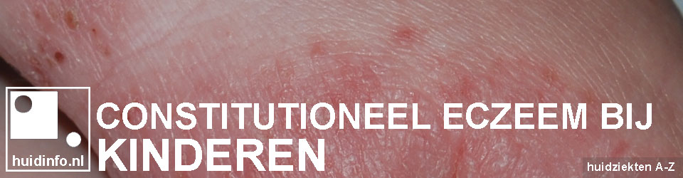 constitutioneel eczeem bij kinderen