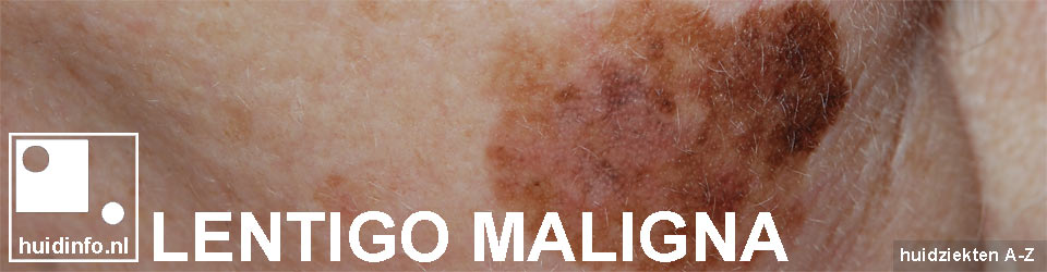 lentigo maligna