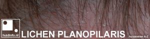 lichen planopilaris