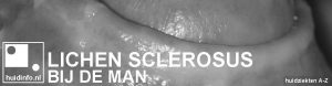 lichen sclerosus bij de man