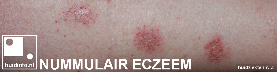 Nummulair Eczeem Huidinfonl Dermatoloog 