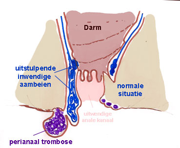 perianaal trombose