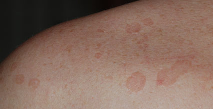 pityriasis versicolor zomergist