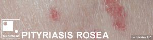 pityriasis rosea