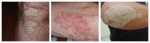 psoriasis vulgaris overzicht