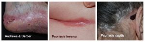 psoriasis inversa, capitis palmoplantaris
