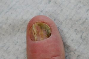 psoriasis nagel