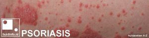 psoriasis informatie folder