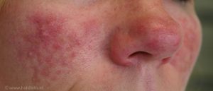 rosacea puistjes roodheid