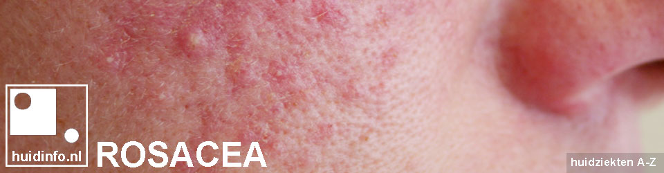 rosacea acne puistjes