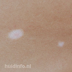 Catastrofe bijlage Schat WITTE PLEKKEN OP DE HUID - FOTO's met oorzaak | huidinfo.nl - dermatoloog