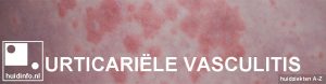 urticariële vasculitis