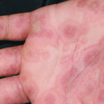 erythema exsudativum multiforme