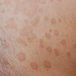 pityriasis versicolor