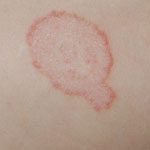 schimmelinfectie (ringworm)