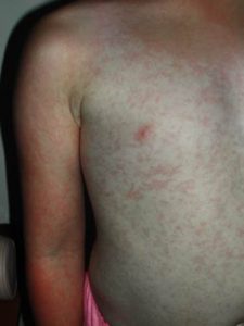 vijfde ziekte Parvo B19 erythema infectiosum