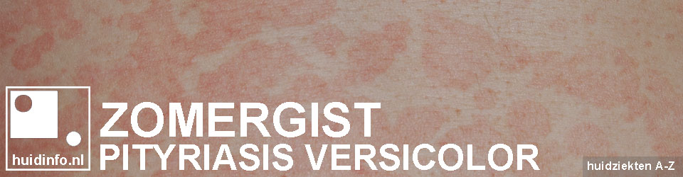 zomergist pityriasis versicolor