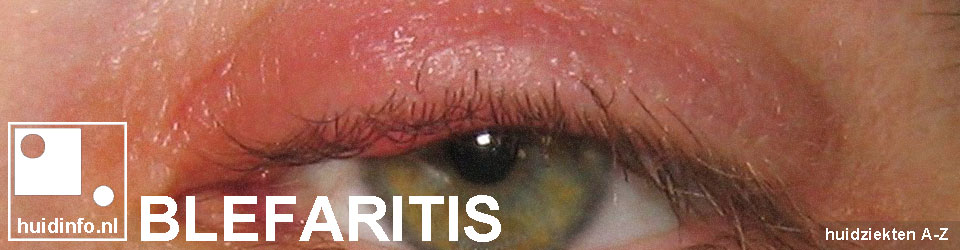 blefaritis ooglidrandontsteking