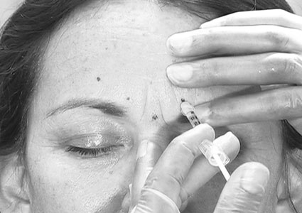 botulinetoxine rimpels botox injecties