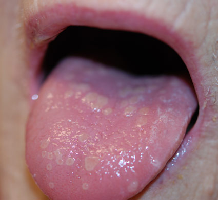 candida in de mond