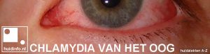 chlamydia van het oog