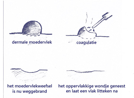 coagulatie (wegbranden)