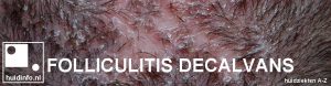 folliculitis decalvans