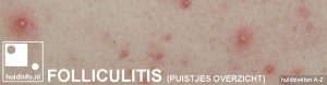 folliculitis ontstoken haarzakjes