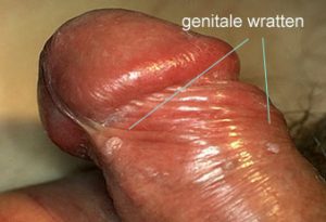 genitale wratten