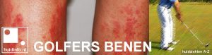 golfersbenen vasculitis