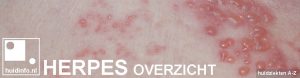 herpes simplex overzicht