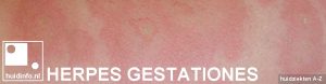 herpes gestationes