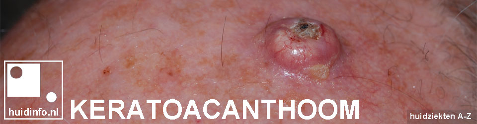 keratoacanthoom