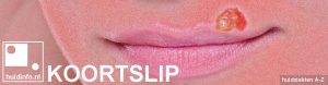 koortslip herpes simplex labialis