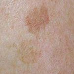 Donkere vlekken op de huid lentigo