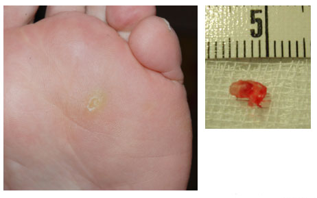 Likdoorn Huidinfo nl Dermatoloog